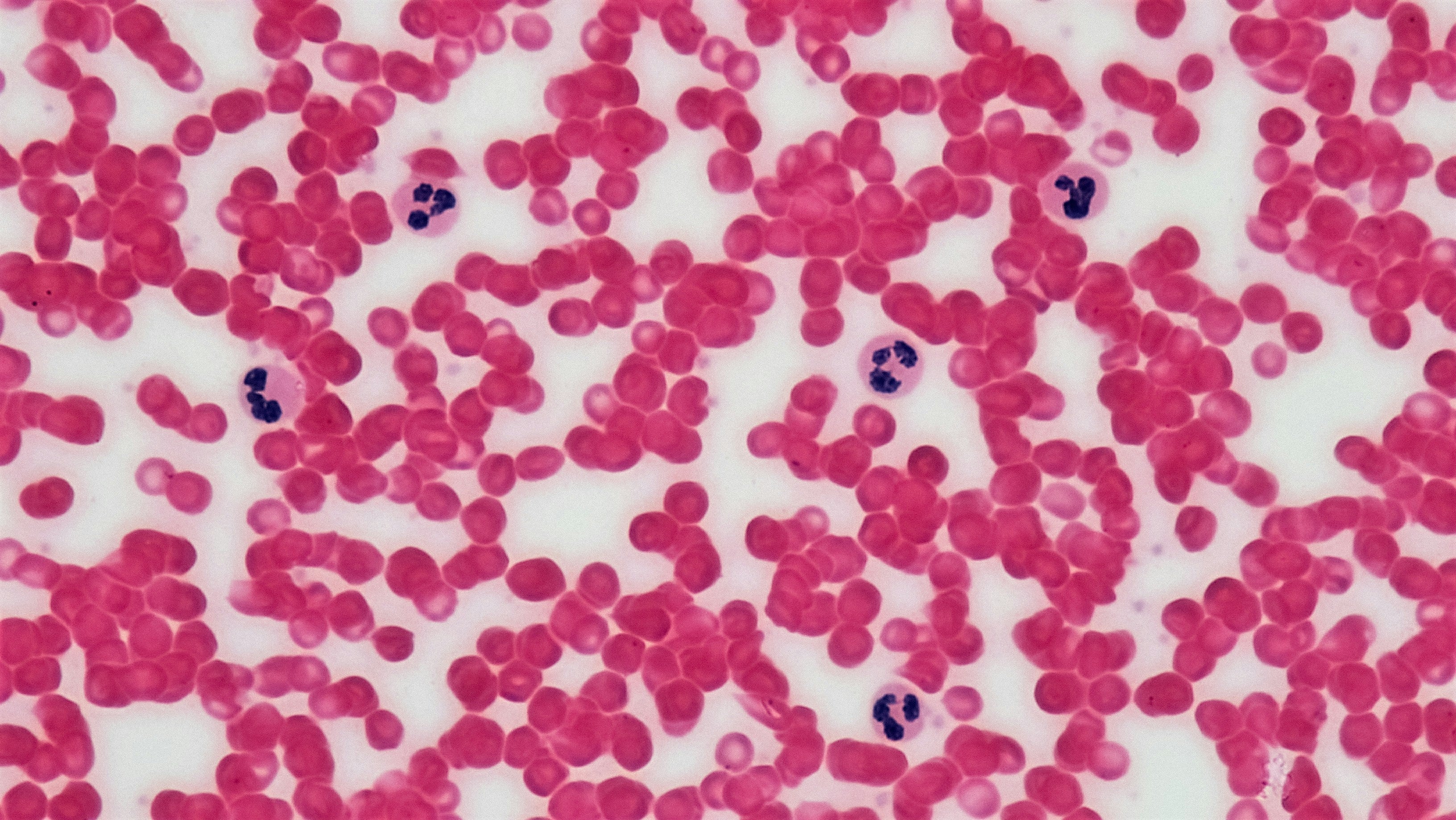 Aplastic Anemia and Cord Blood: What Families Need to Know