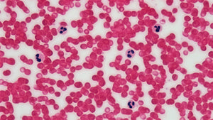 Aplastic Anemia and Cord Blood: What Families Need to Know